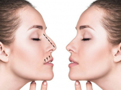 Уникальный метод бескровной хирургии представили ученые: форму носа можно изменить без операции