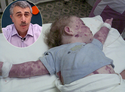 За вспышкой кори на Украине придет дифтерия, а это в сотни раз хуже, - доктор Комаровский 