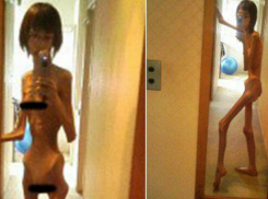 Девушка, которая от издевательств истощала до 17 кг, показала свои жуткие фото