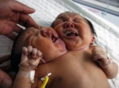 Младенца с двумя головами, родившегося в Индии, показали на видео