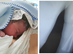 Пара из Бельц обвиняет врачей в халатности: их ребенок родился со сломанной рукой