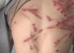 В Ниспоренах отец изуродовал 13-летнего сына за курение и плохую учебу