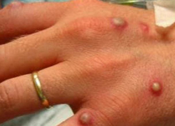 В Молдове ищут людей, с которыми контактировал иностранец, заболевший оспой обезьян 