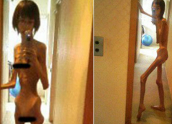 Девушка, которая от издевательств истощала до 17 кг, показала свои жуткие фото