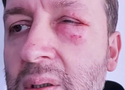 Решетников сильно упал прямо на глаз и оказался в больнице