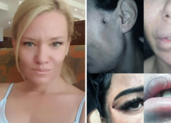 "Косметолог" из Молдовы изуродовала пациенток в Румынии