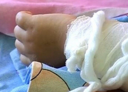 Пятилетняя девочка перевернула на себя чайник с кипятком в Приднестровье