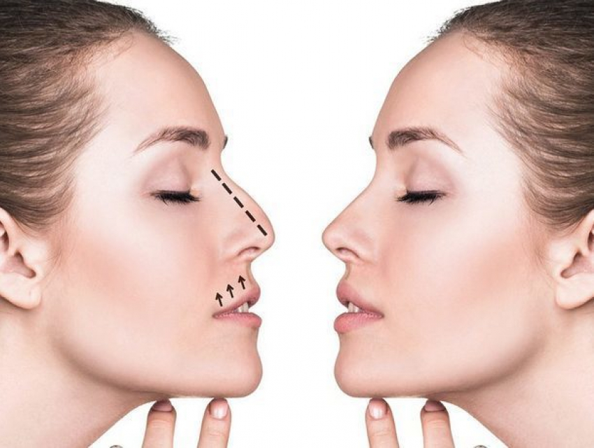 Уникальный метод бескровной хирургии представили ученые: форму носа можно изменить без операции