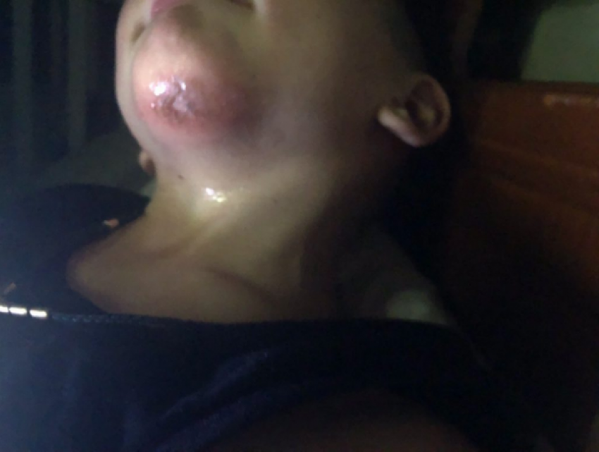 В Бендерах ребенок провалился в канализацию и разбил лицо