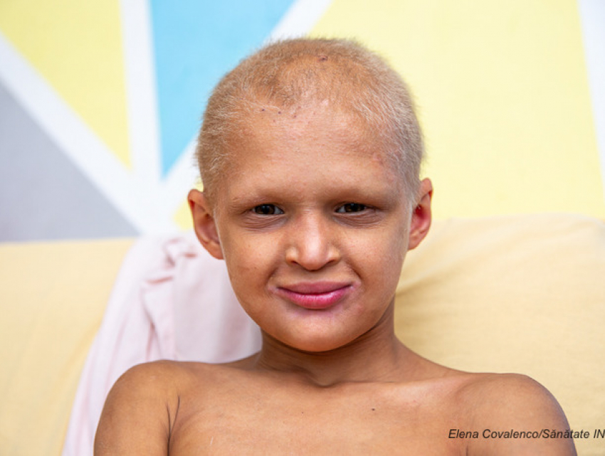 Редкое заболевание: история 8-летнего ребенка из Молдовы, который живет без зубов, с седыми волосами и не умеет потеть