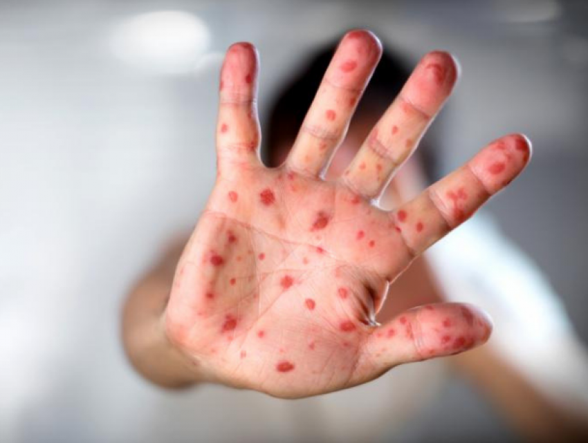 В Молдове подтверждено 25 случаев заболевания кори за 2019 год